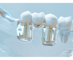 Dentsply Sirona – Mit neuem Restrukturierungsprogramm auf Mittelfristziel hinarbeiten